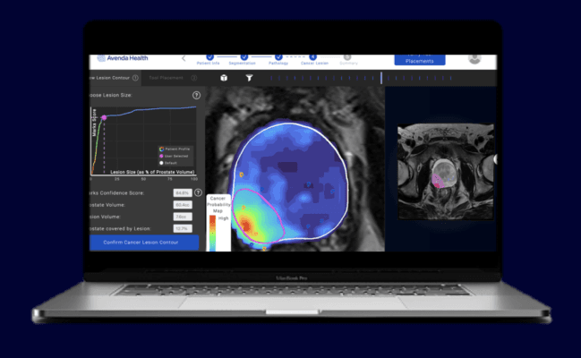 Avenda Health Unveils Unfold AI: Precision Cancer Diagnosis Breakthrough