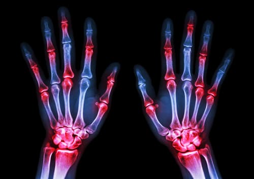 AI Vision Models Leap Forward: Automated Rheumatoid Arthritis Diagnosis Matches Radiologists